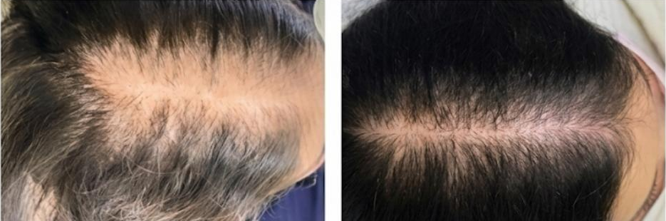 Before and after — PRP Hair Restoration at GlowMed Aesthetics Waterdown
